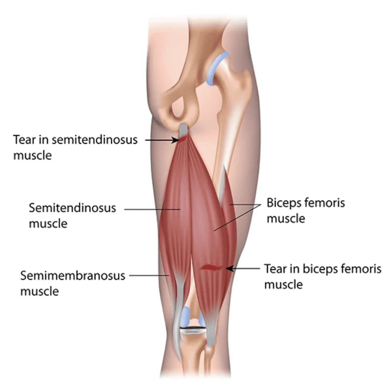 4th Hamstring Preventing Hamstring Injuries